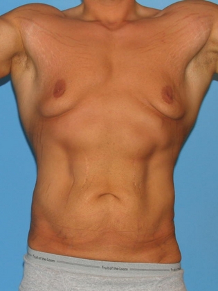Steroid damage to body